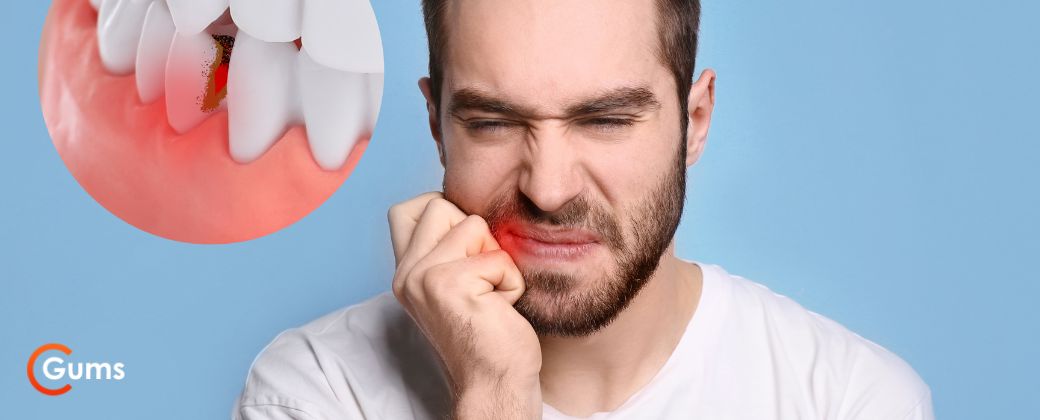 איך להוריד נפיחות בחניכיים: בחור מחזיק את הלחי כתוצאה מחניכיים כואבות. בצדג שמאל למטה לוגו אתר "gums" ובצד שמאל למעלה תמונה קטנה של חניכיים ושיניים. 